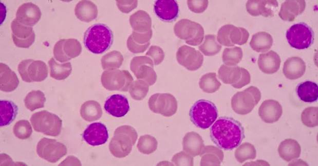 Día Mundial de la Leucemia Mieloide Crónica